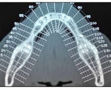 Preparazione sito implantare con piezosurgery in cresta ossea sottile densità d1