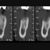 Piezosurgery implant site preparation with KAPS SOM 62 operative microscope