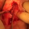 Piezosurgery apicoectomy with kaps som 62 microscope