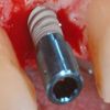 Piezosurgery mis implant in very narrow ridge