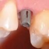 Piezosurgery 3.8mm implant in narrow ridge with prosthetic solution