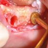 Piezosurgery upper 25 26 IMPLADENT SHARP conical implants