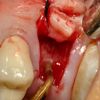 Piezosurgery minimally invasive approach for 1'st upper molar replacement