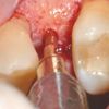 Piezosurgery implant site in very narrow mesio-distal space