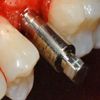 Piezosurgery implant site in very narrow crest