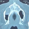 Piezosurgery removal of cyst close to maxillary sinus