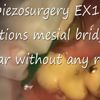 Piezosurgery flapless complicated extraction of ankylosed root