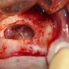 Sinus lift piezosurgery.wmv