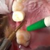 piezosurgery immediate implant after piezoperiotomy of ankylosed root