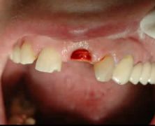 Facile e rapida sostituzione provvisoria di denti estratti