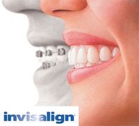 INVISALIGN - Ortodonzia ESTETICA