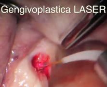 Gengivoplastica LASER