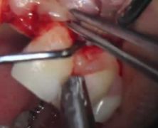 Impianto con tecnica split-crest per agenesia incisivo laterale superiore