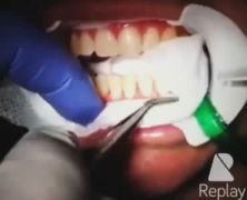 Sbiancamento dentale con sistema GLO