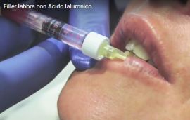 Filler labbra con acido ialuronico