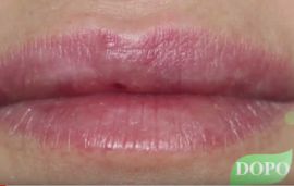 Medicina estetica: filler labbra con acido ialuronico a Siena