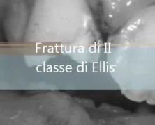 Duplice frattura di II classe di Ellis