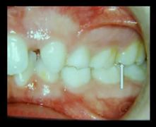 Damon il sistema ortodontico meraviglioso