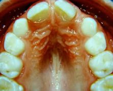 L'apparecchio  ortodontico  di Damon, ortodonzia senza  limiti , affollamento  gravissimo