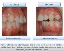 2a Classe Suddivisione: asimmetria e retrusione mandibolare