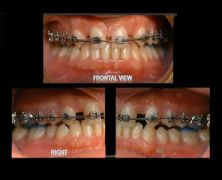 Multidisciplinary Orthodontic Treatment