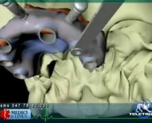 Implantologia computerizzata