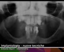 Implantologia, nuove tecniche