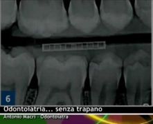 Odontoiatria... senza trapano