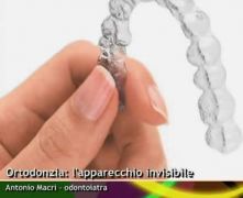 Ortodonzia: l'apparecchio invisibile