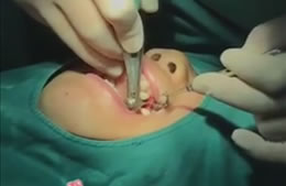 Inserimento impianto dentale