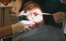 Di paura da dentista si guarisce: estrazione in paziente ex-fobico