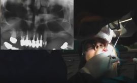 Rialzo seno mascellare in sedazione cosciente in paziente con paura del dentista