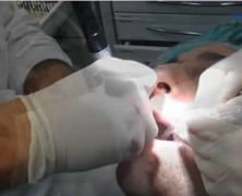 Sedazione cosciente per endovena in paziente fobico per estrazione di molare inferiore