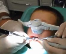 Paura del dentista: sedazione con protossido d'azoto per cure di denti decidui in bimbo di 5 anni