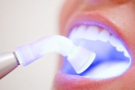 Sbiancamento Dentale e Garanzia di QualitÃ 