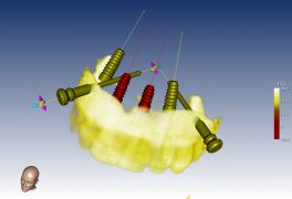 Implantologia computer guidata arcata superiore