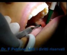 Estrazione Dente del Giudizio mini invasiva con Piezo Surgery