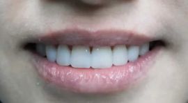 Faccette Dentali Estetiche