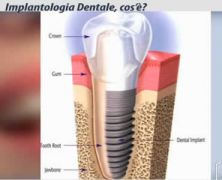 cos'è l'implantologia dentale
