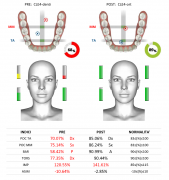 Analisi EMG dei contatti occlusali