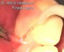 Frenulectomia Laser assistita