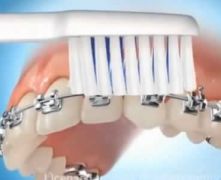 Apparecchio dei denti: istruzioni per l'uso