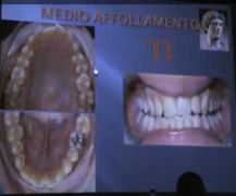 Corso di ortodonzia linguale: caso medio affollamento lingual orthodontic orazio bennici