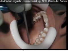 Corso di Ortodonzia Linguale: costruz build up. Dott. Orazio M. Bennici