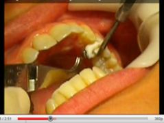 Ortodonzia Linguale: rimozione degli JIG. Lingual Orthodontic